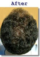 Hair Loss Results after Revivogen Growth