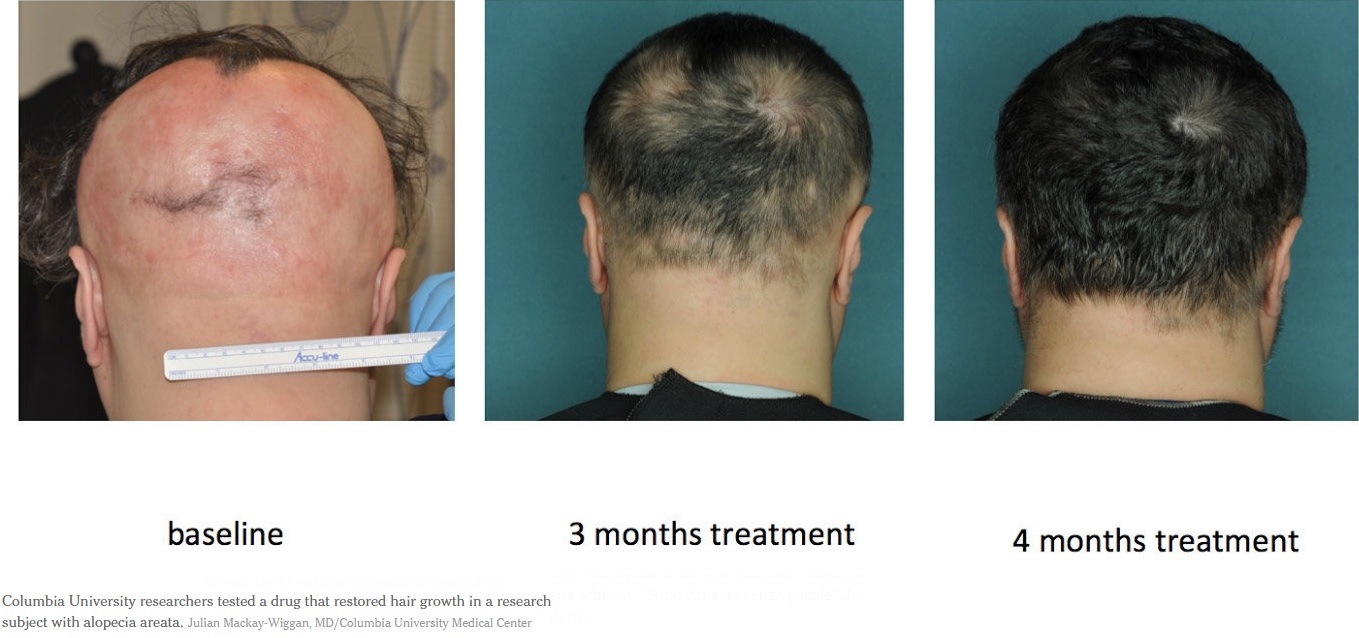 Effetti del Ruxolitinib sull'alopecia areata - Ruxolitinib effects
